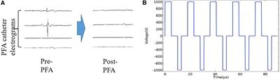 A pilot clinical assessment of biphasic asymmetric pulsed field ablation catheter for pulmonary vein isolation